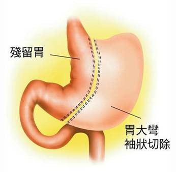 缩胃术