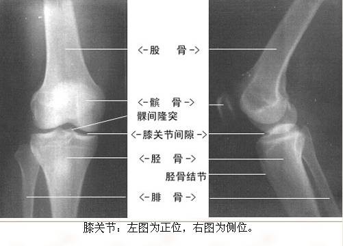 膝关节急性滑膜炎