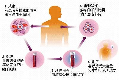 自体干细胞移植