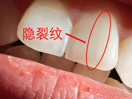 隐裂牙