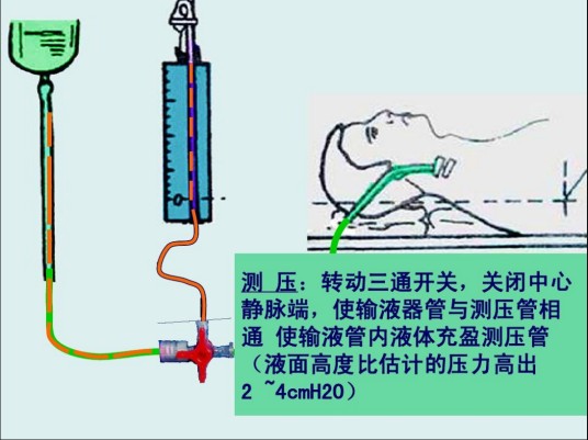 中心静脉压测定