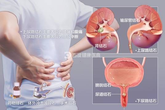 泌尿系统结石