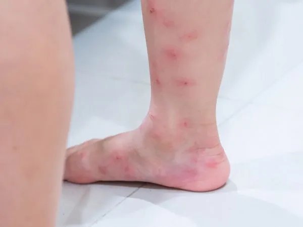 家里发现小红蚂蚁怎么消灭
