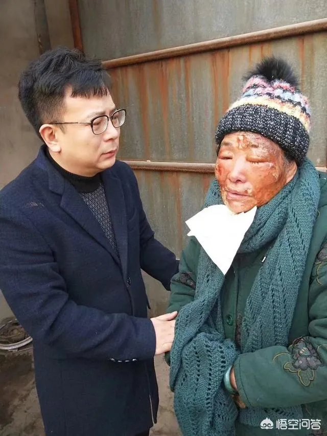 保定一老人卖房救助流浪狗,救助站不慎失火,为抢救狗狗烧伤半边脸,这个事你怎么看?