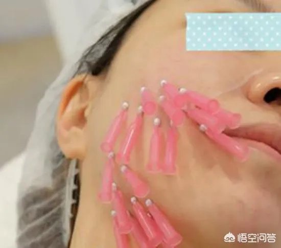 面部提升埋线是怎么回事？