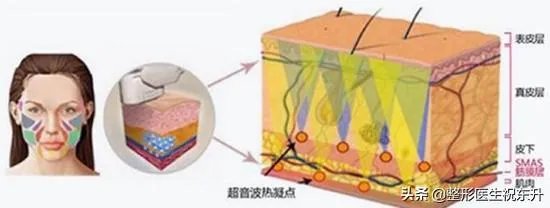 超声刀危害有哪些?