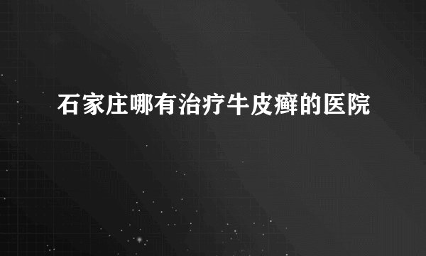 石家庄哪有治疗牛皮癣的医院