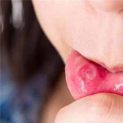 口疮的快速治疗方法有什么