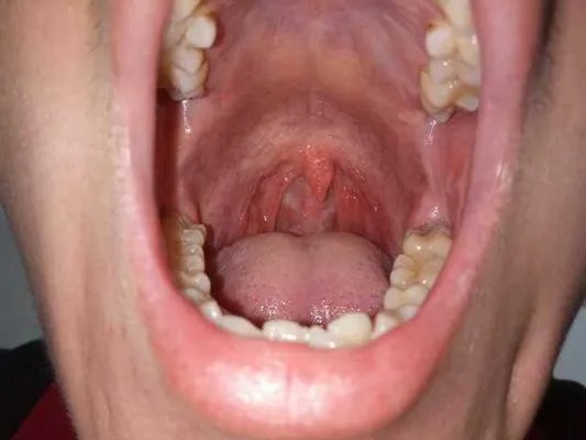 白喉病症状?