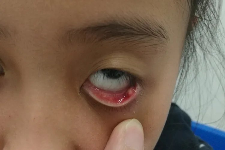 眼疖子图片