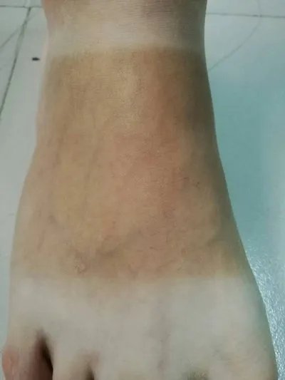 湿疹和皮炎一样吗?