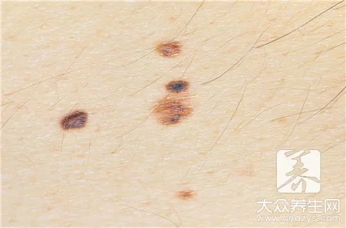  手术去痣后的三个月图