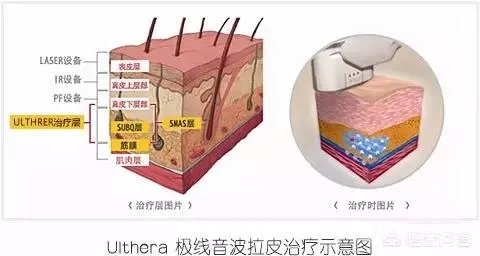 超声刀危害有哪些?