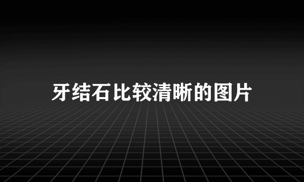 牙结石比较清晰的图片