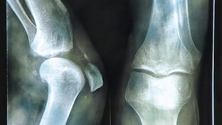 股骨头缺血性坏死应该做哪些检查？