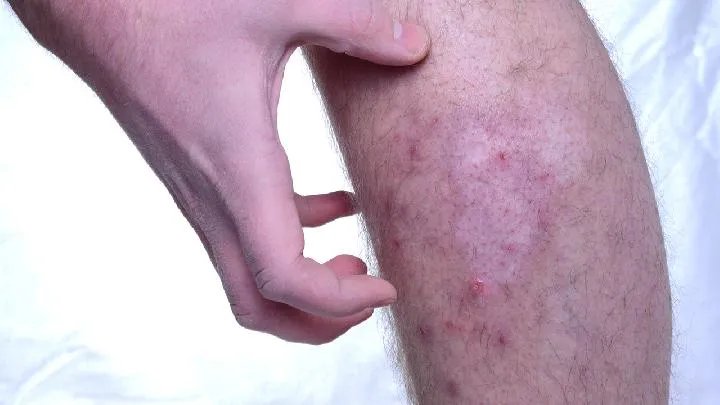 怎么预防盘状红斑狼疮呢?