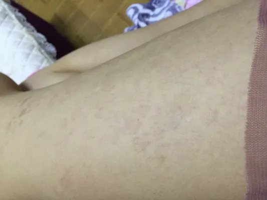 湿疹和皮炎一样吗?