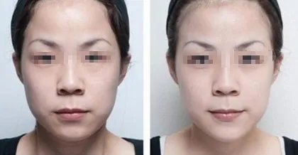 苏州做面部脂肪填充哪家医院好？