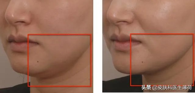 超声刀危害有哪些?