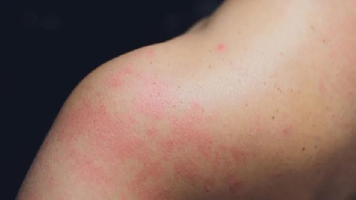 怎么预防盘状红斑狼疮呢？