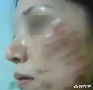 超声刀危害有哪些?