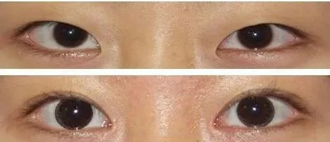 割双眼皮到底该不该开不开眼角?