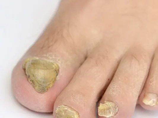 甲沟炎的治疗