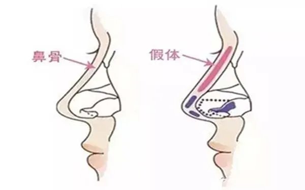 隆鼻大概要多少钱