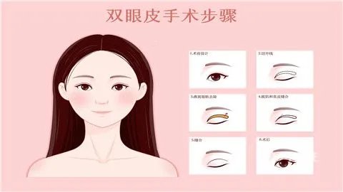 割双眼皮的价格