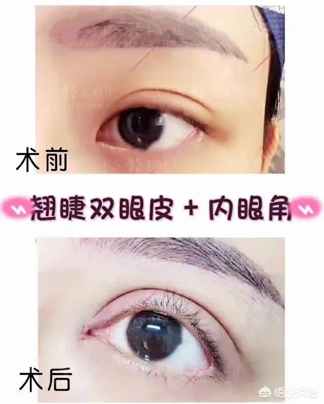 割双眼皮到底该不该开不开眼角?