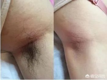 怎样简单除腋毛?