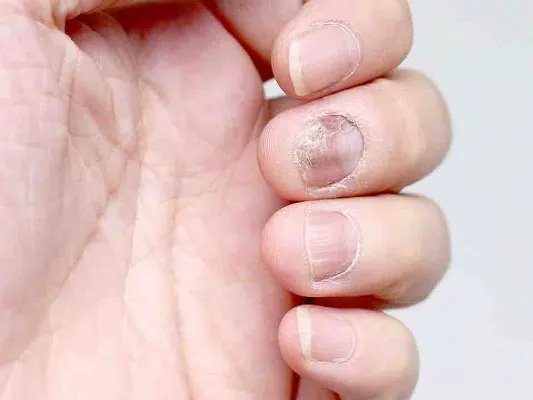 灰指甲最佳治疗方法