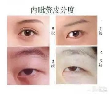 割双眼皮到底该不该开不开眼角?