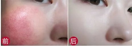 激光祛红血丝多少钱