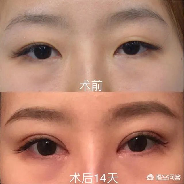 割双眼皮到底该不该开不开眼角?