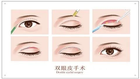 割双眼皮的价格