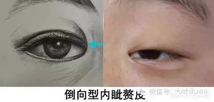割双眼皮到底该不该开不开眼角?