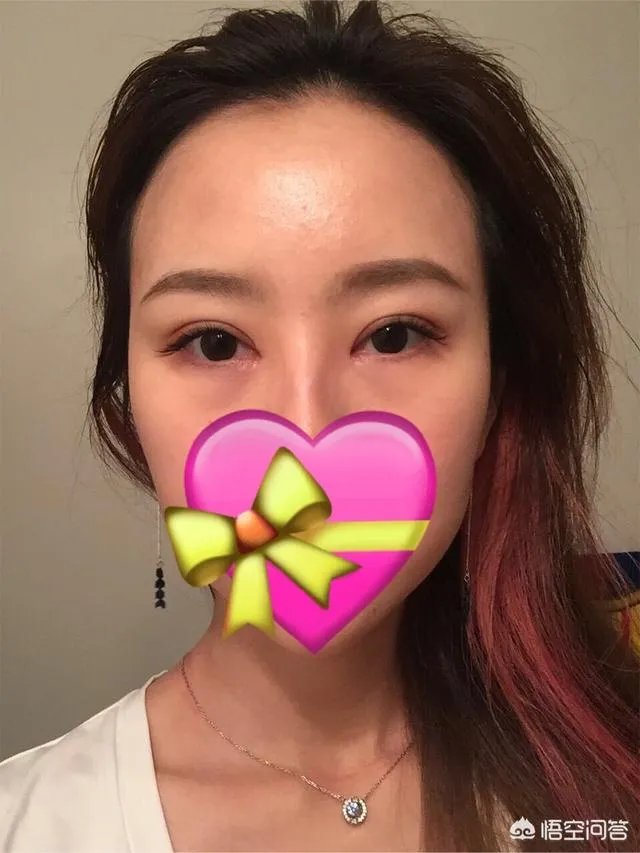 割双眼皮到底该不该开不开眼角?