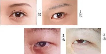 割双眼皮到底该不该开不开眼角?