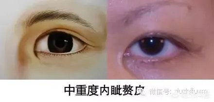 割双眼皮到底该不该开不开眼角?