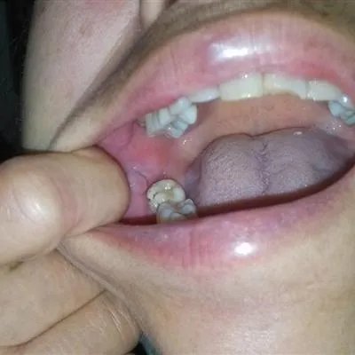 治疗牙疼