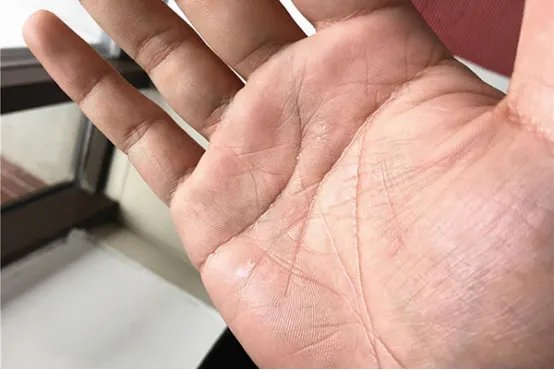盗汗的原因有哪些