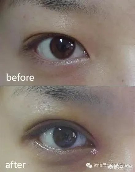 割双眼皮到底该不该开不开眼角?