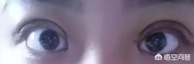 割双眼皮到底该不该开不开眼角?