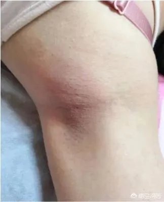 怎样简单除腋毛?