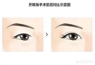 割双眼皮到底该不该开不开眼角?