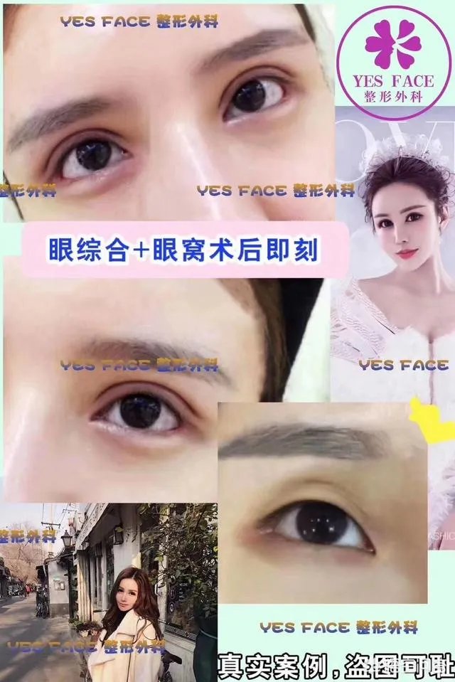 割双眼皮到底该不该开不开眼角?
