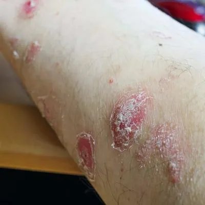 牛皮癣用啥药好的快