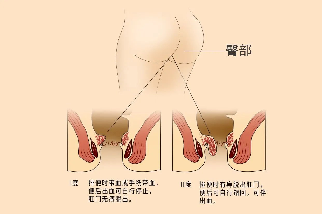 轻度痔疮图片大全