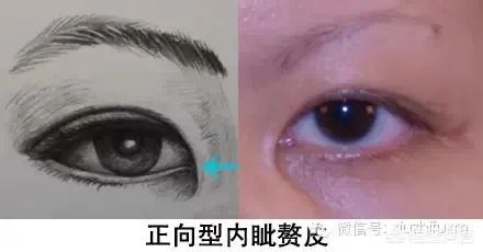 割双眼皮到底该不该开不开眼角?